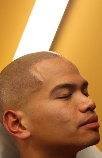 Final result of scalp micropigmentation in Montreal – short hair shaved look