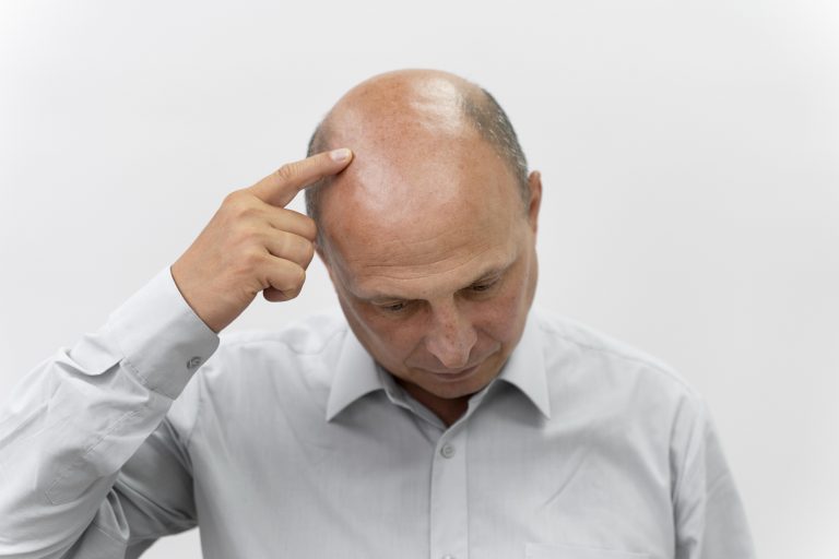 Man undergoing scalp micropigmentation (SMP) treatment to camouflage baldness in Montreal, Quebec.
